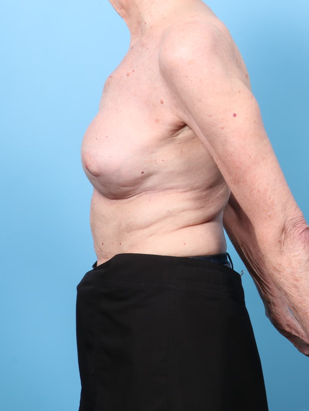 Breast Implant Revision case #9008 after, image 3
