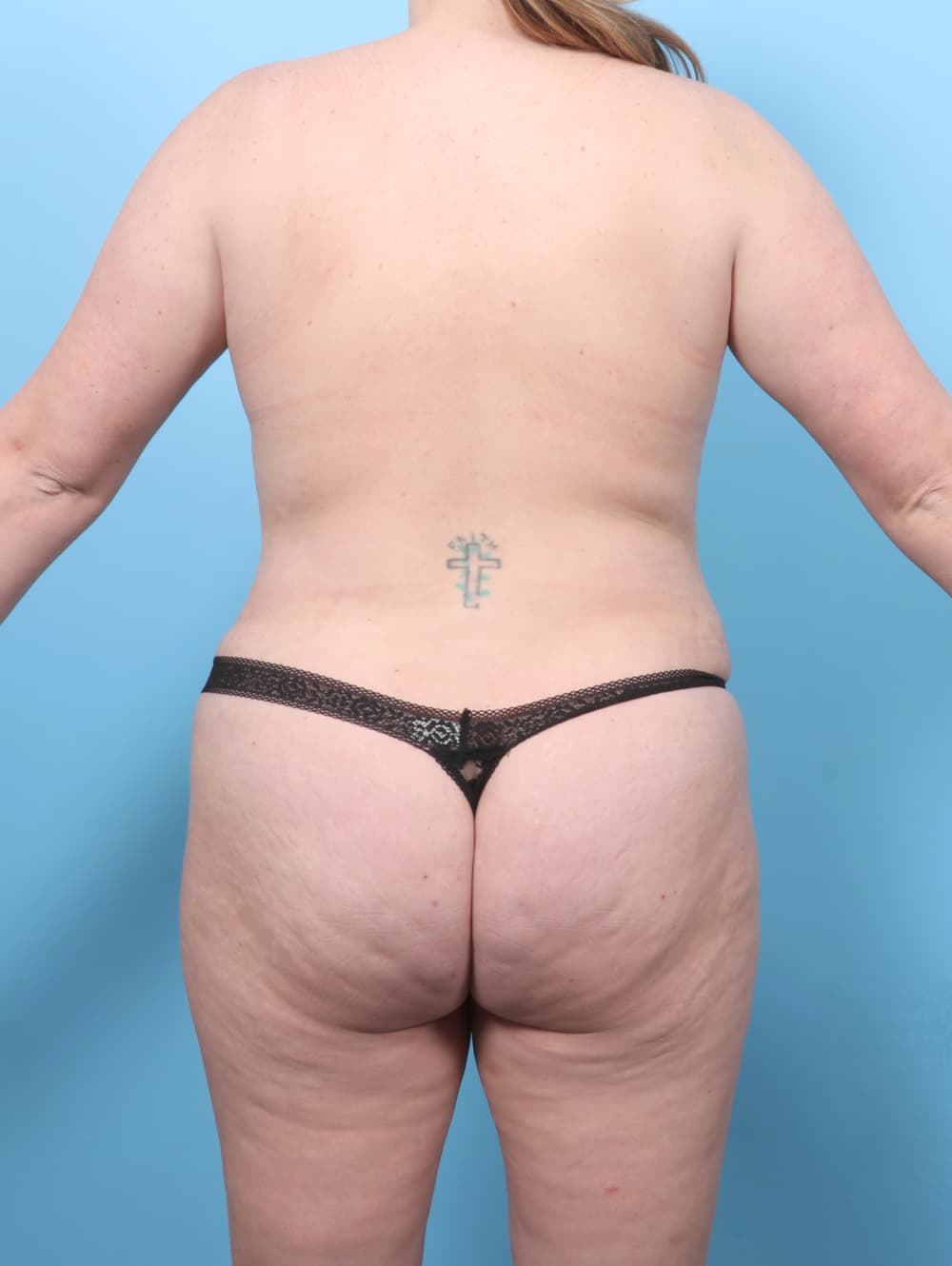 Tummy Tuck case #7650 after, image 2