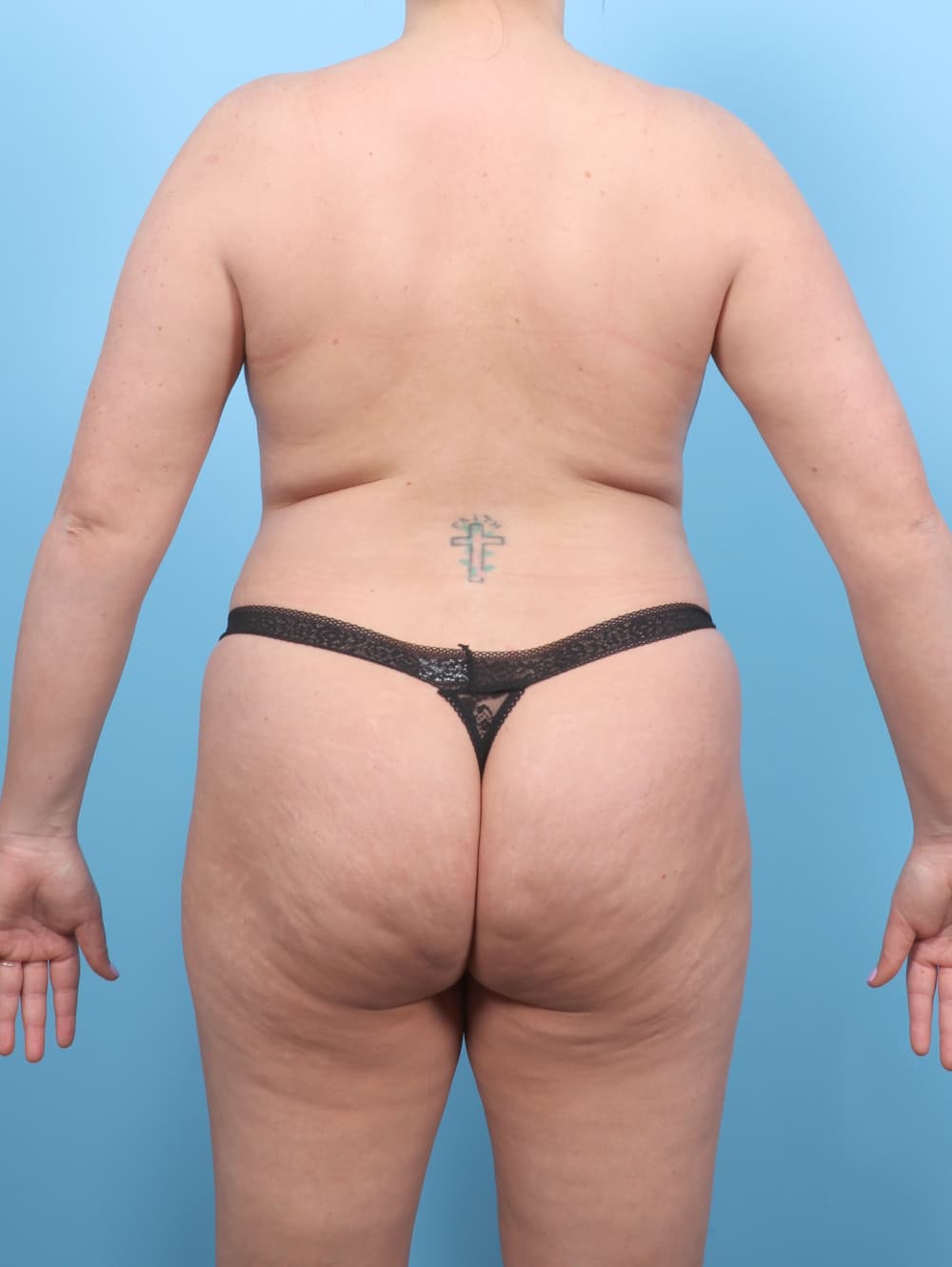 Tummy Tuck case #7650 before, image 2