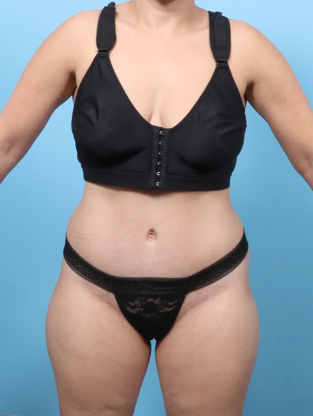 Tummy Tuck case #8255 after, image 1