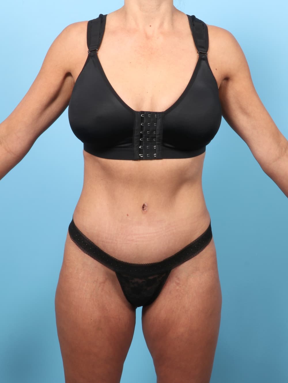 Tummy Tuck case #9023 after, image 1