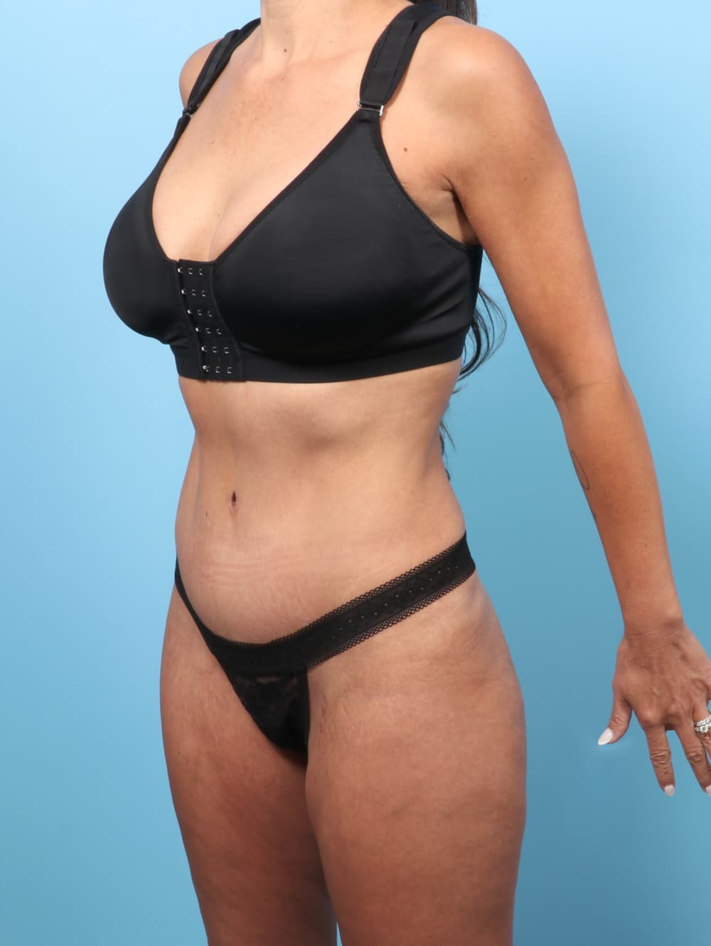 Tummy Tuck case #9023 after, image 2