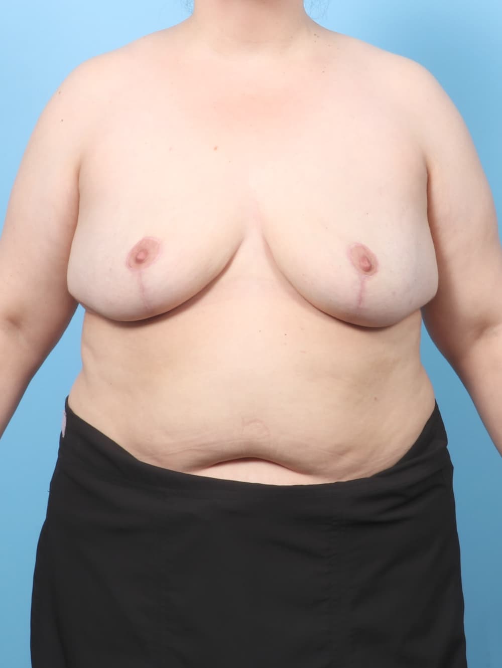 Breast Implant Removal with Lift case #9002 after, image 1