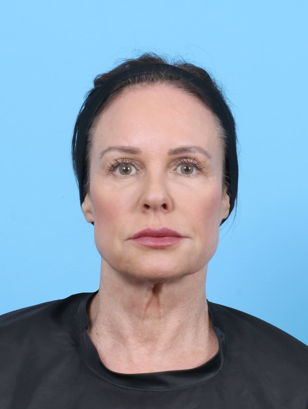 Facelift case #6261 before