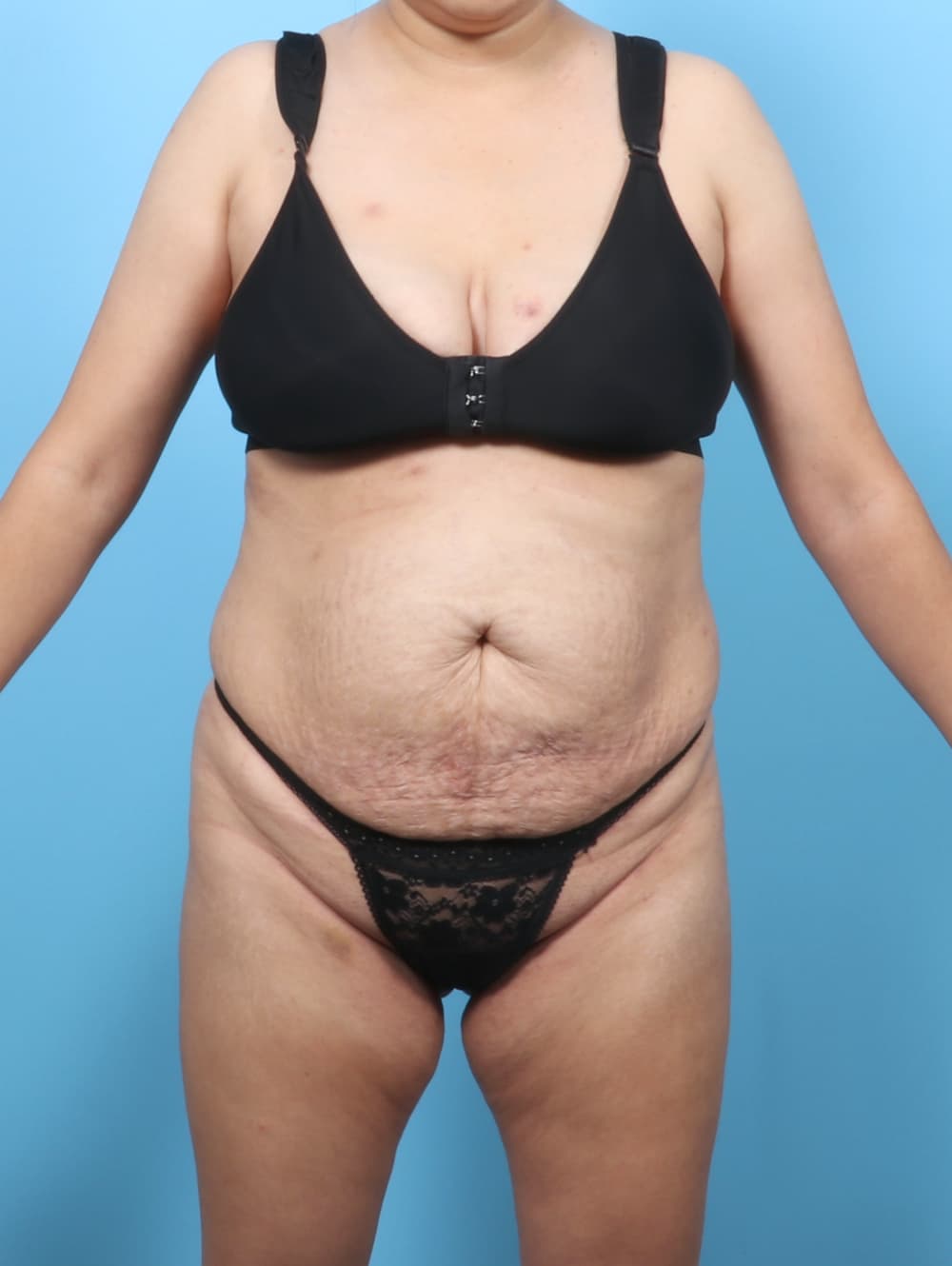 Tummy Tuck case #9033 before, image 1