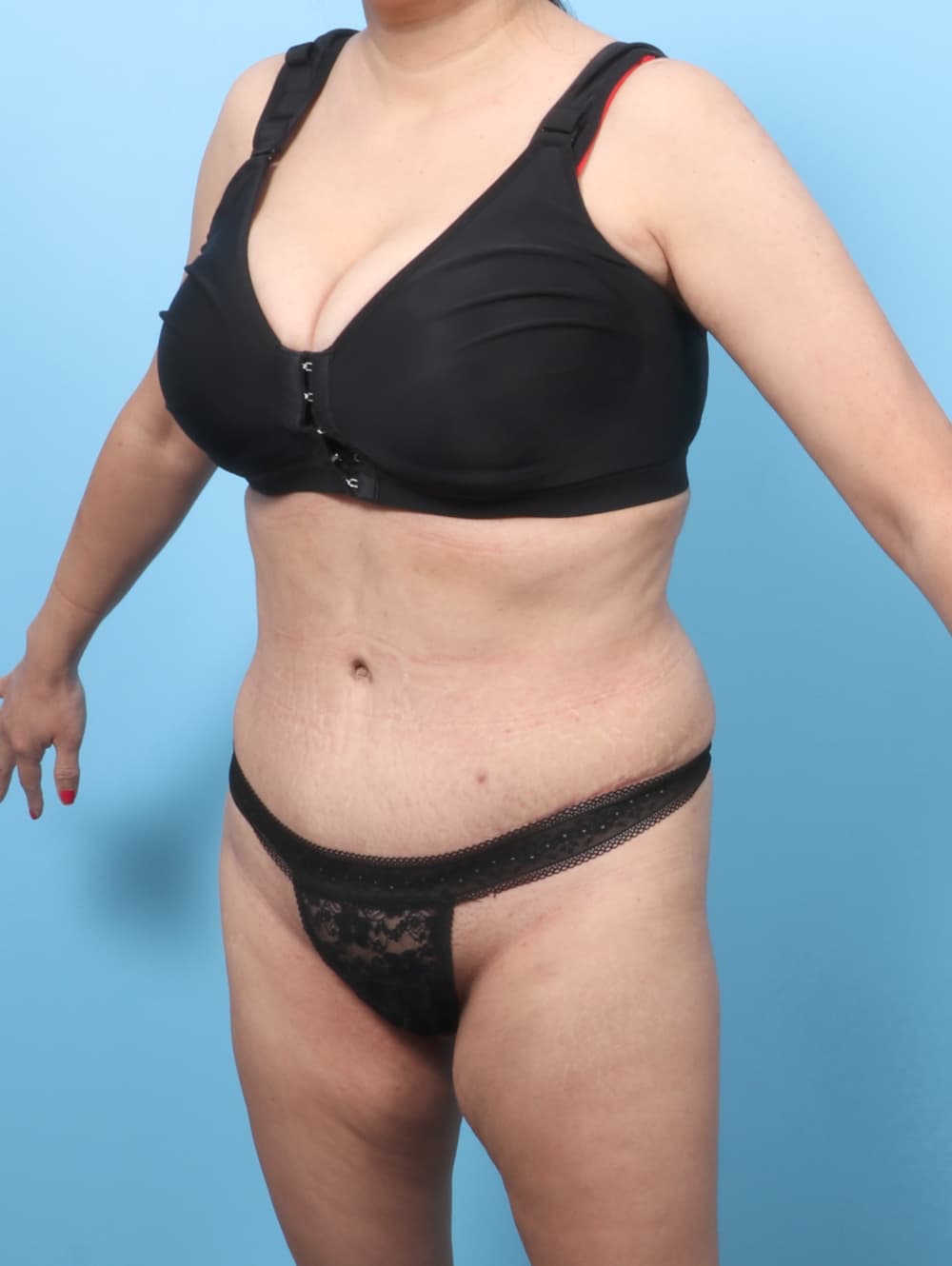 Tummy Tuck case #9033 after, image 3