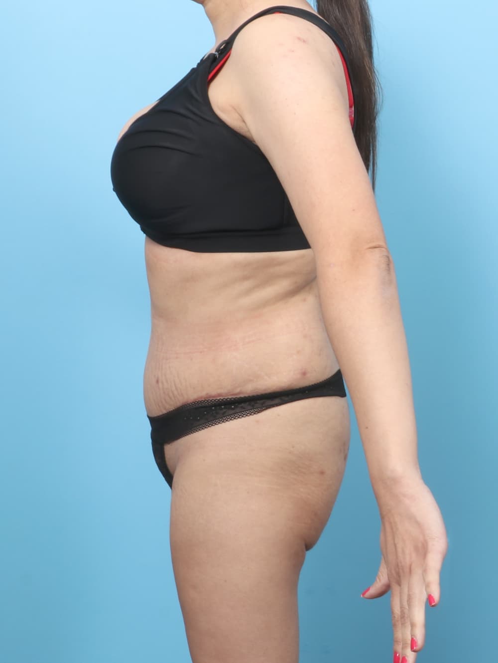 Tummy Tuck case #9033 after, image 2