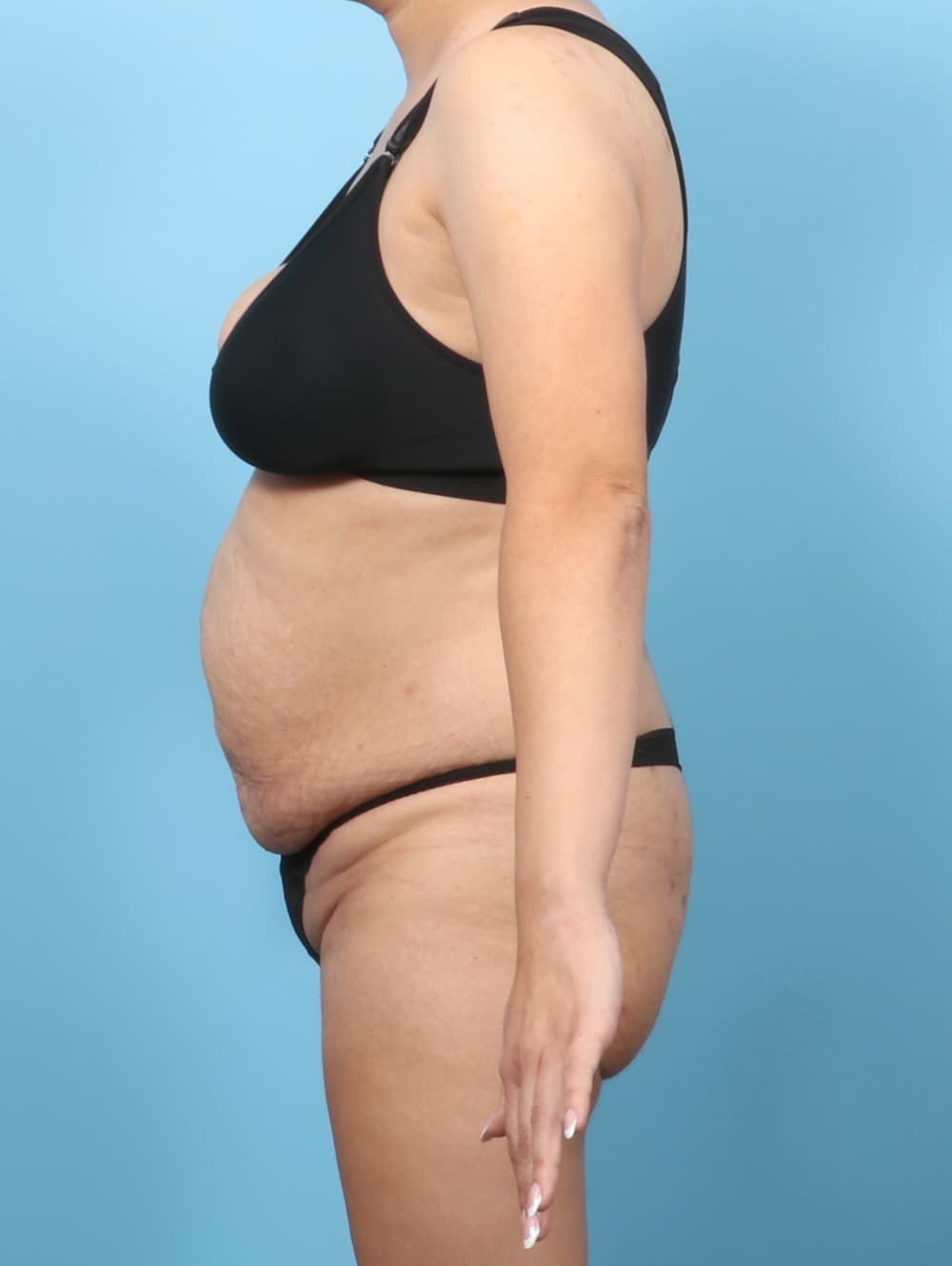 Tummy Tuck case #9033 before, image 2