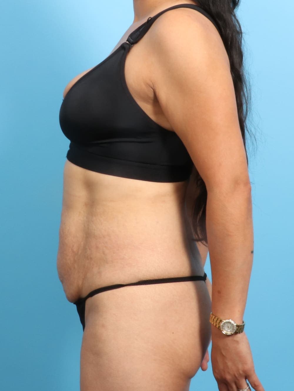 Tummy Tuck case #2298 before, image 3