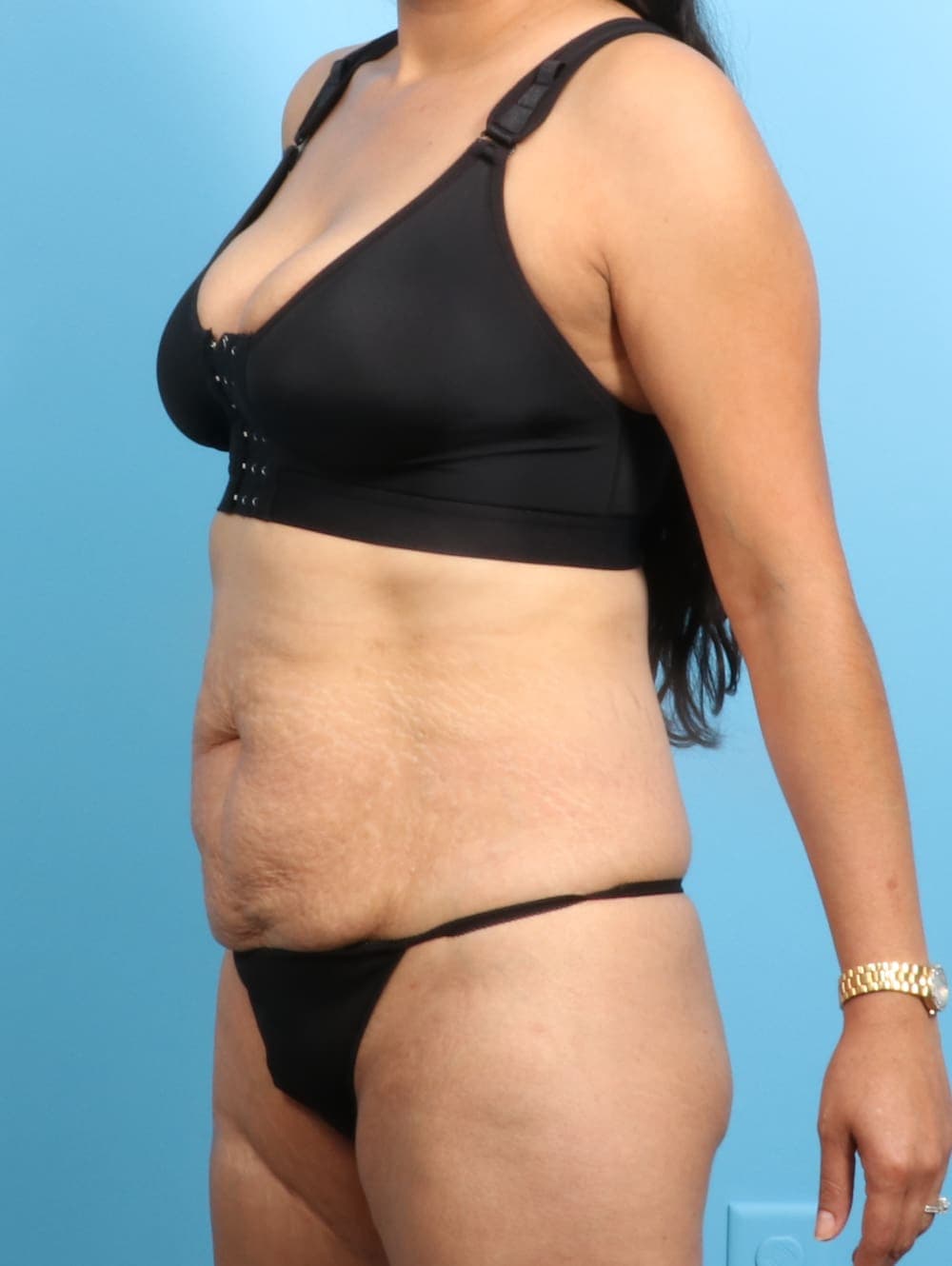 Tummy Tuck case #2298 before, image 2