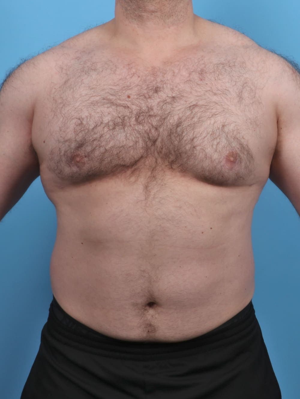 Male Breast Reduction case #5042 after, image 1