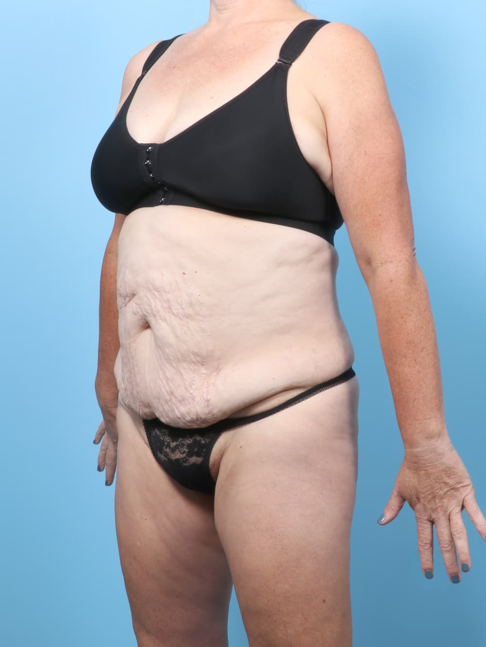 Tummy Tuck case #8998 before, image 2