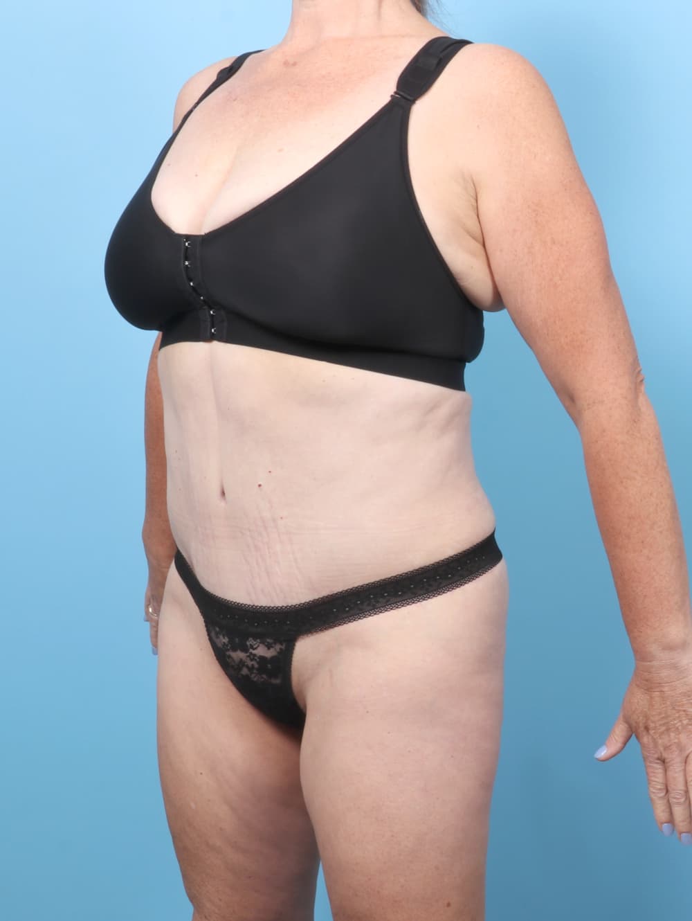 Tummy Tuck case #8998 after, image 2