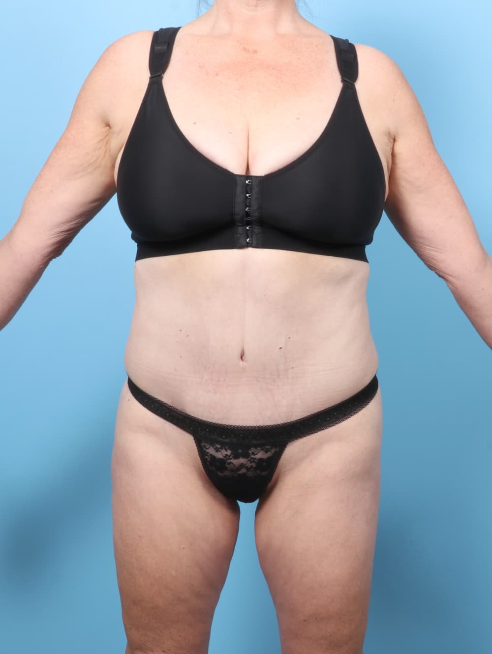 Tummy Tuck case #8998 after, image 1