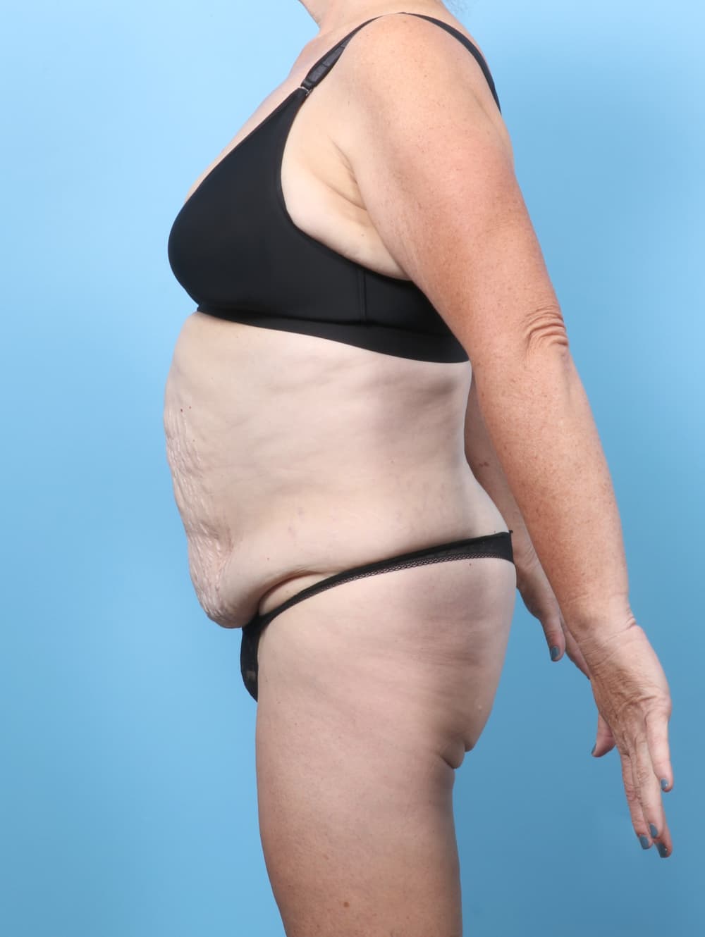 Tummy Tuck case #8998 before, image 3