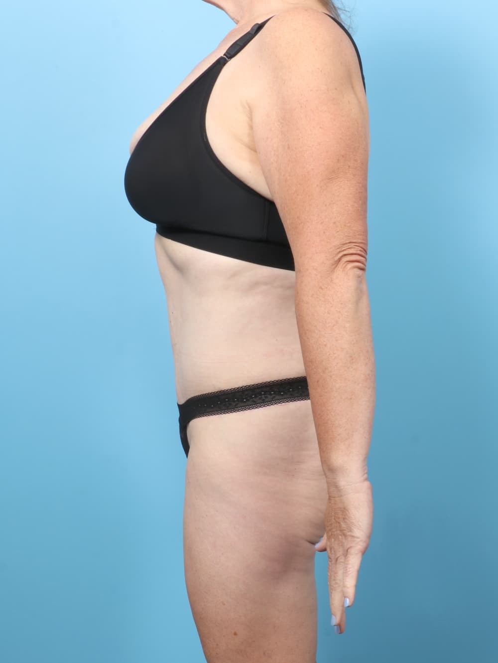 Tummy Tuck case #8998 after, image 3