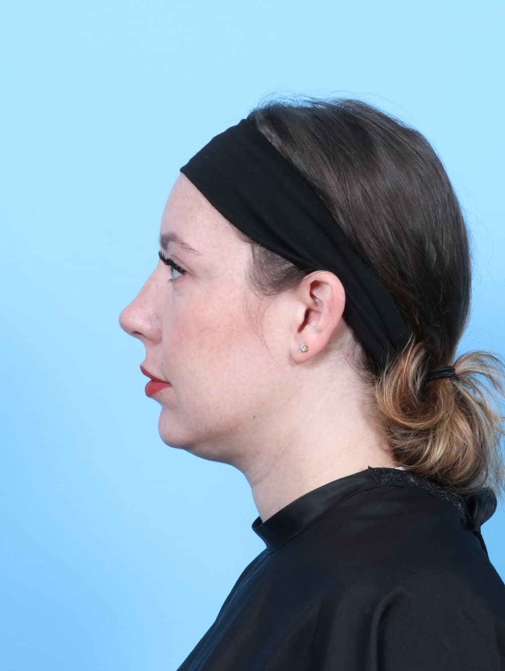 Rhinoplasty case #7289 after, image 1