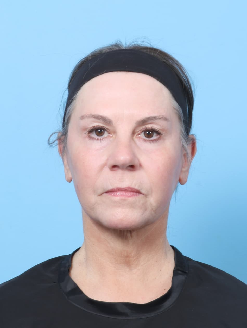 Facelift case #8394 after