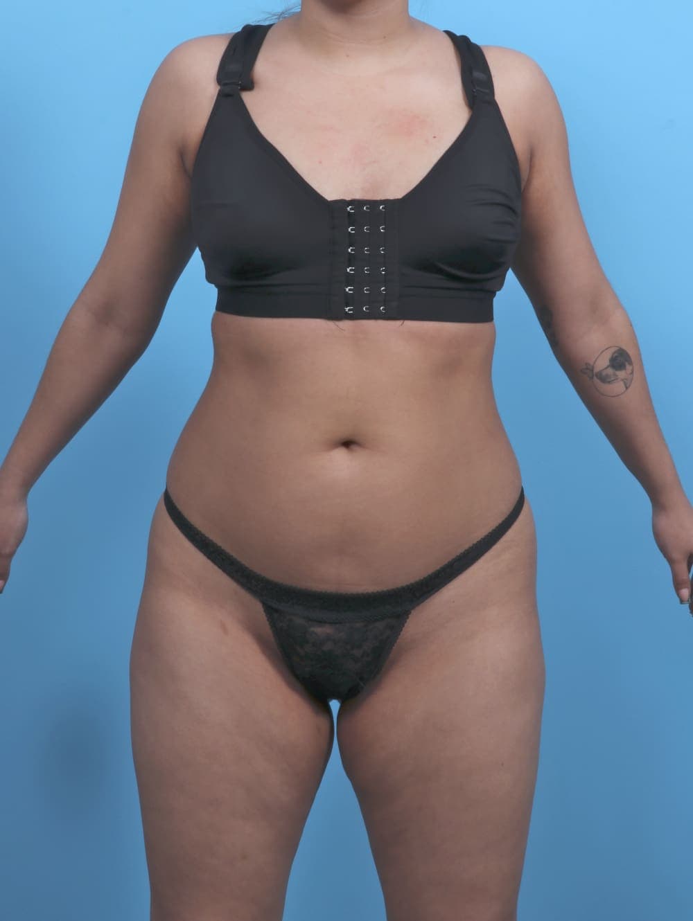Liposuction case #5976 before, image 1