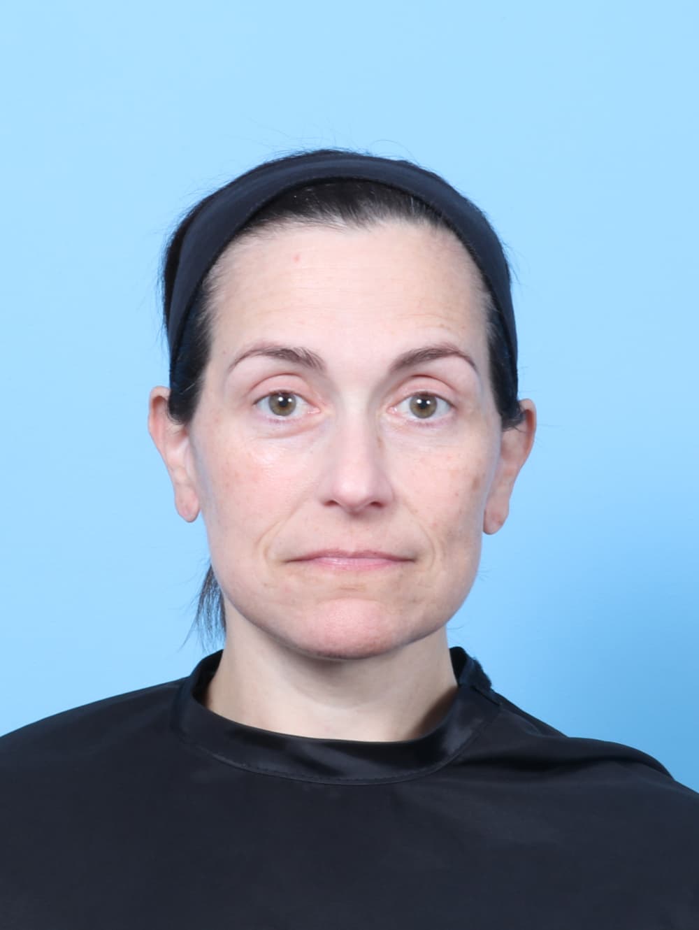 Eyelid Surgery case #8748 after, image 1