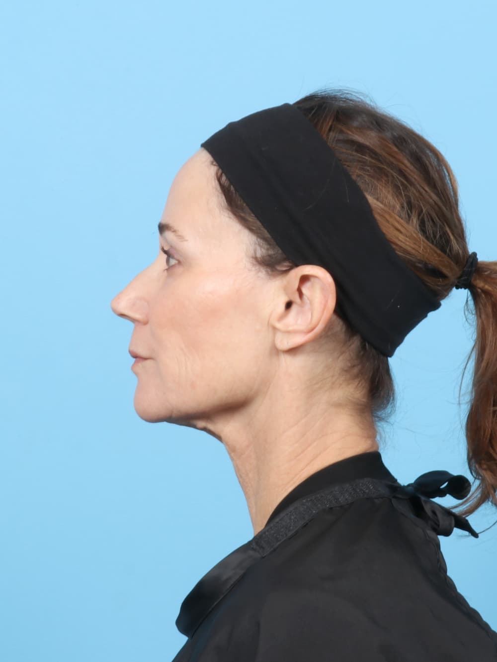 Facelift case #7313 before, image 4