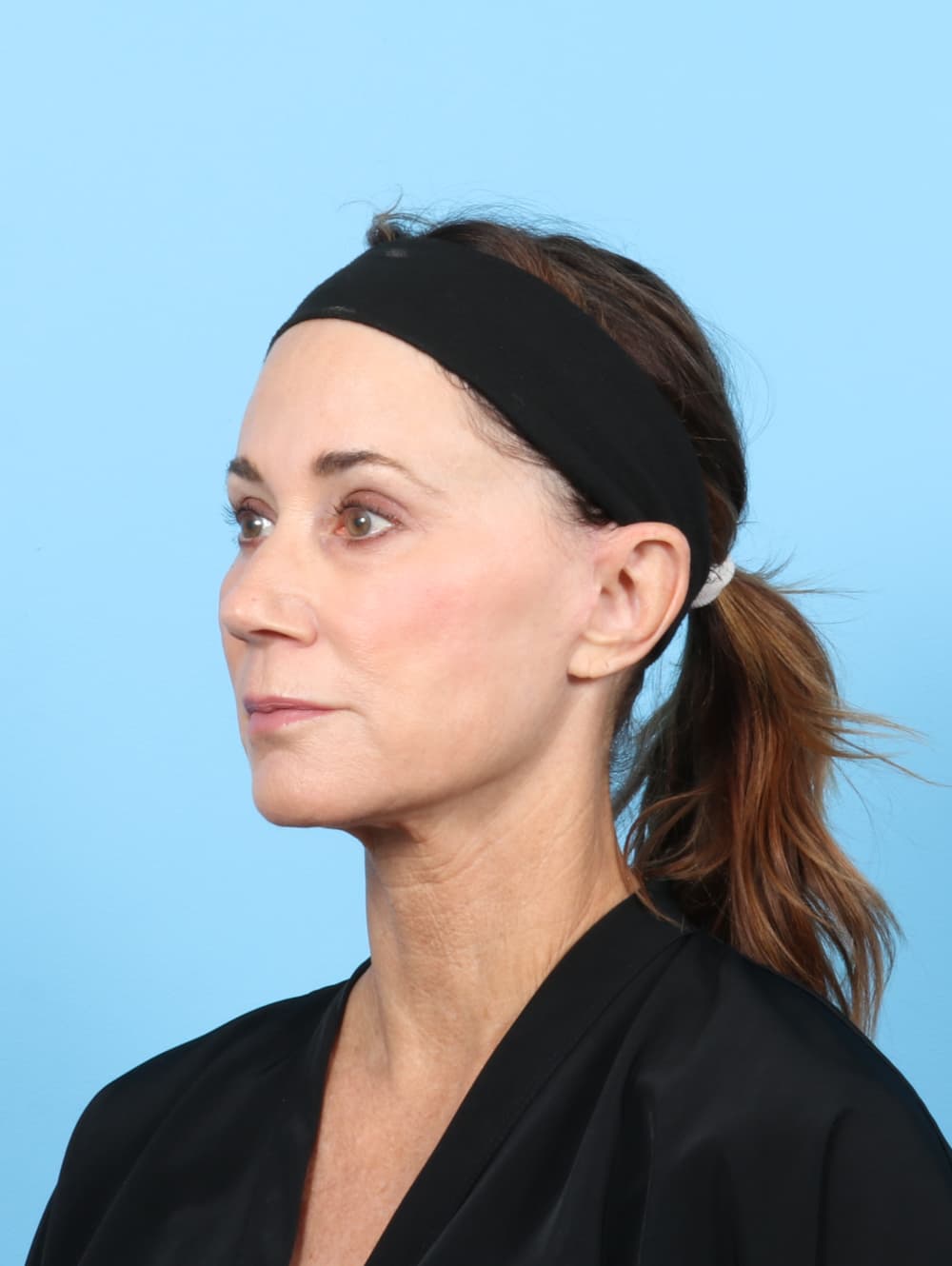 Facelift case #7313 after, image 3
