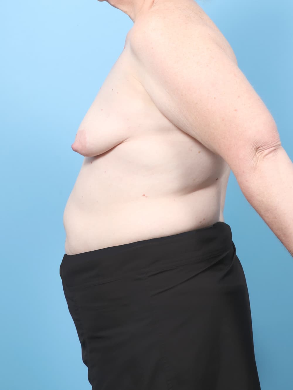 Breast Lift with Implants case #9011 before, image 3