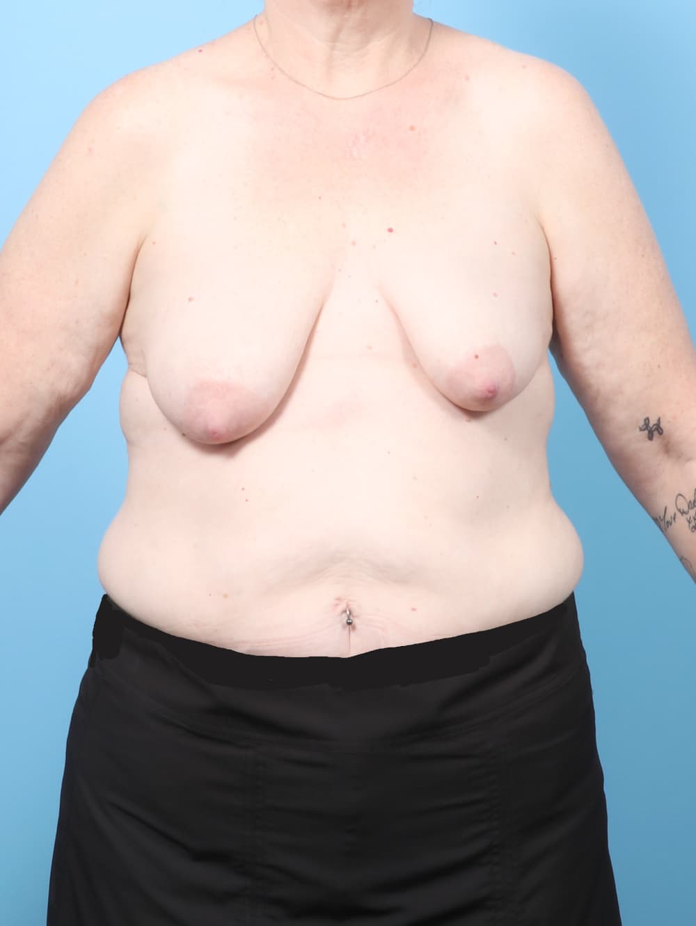 Breast Lift with Implants case #9011 before