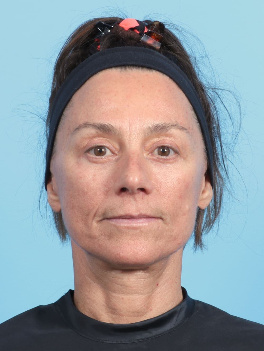 Facelift case #2536 after