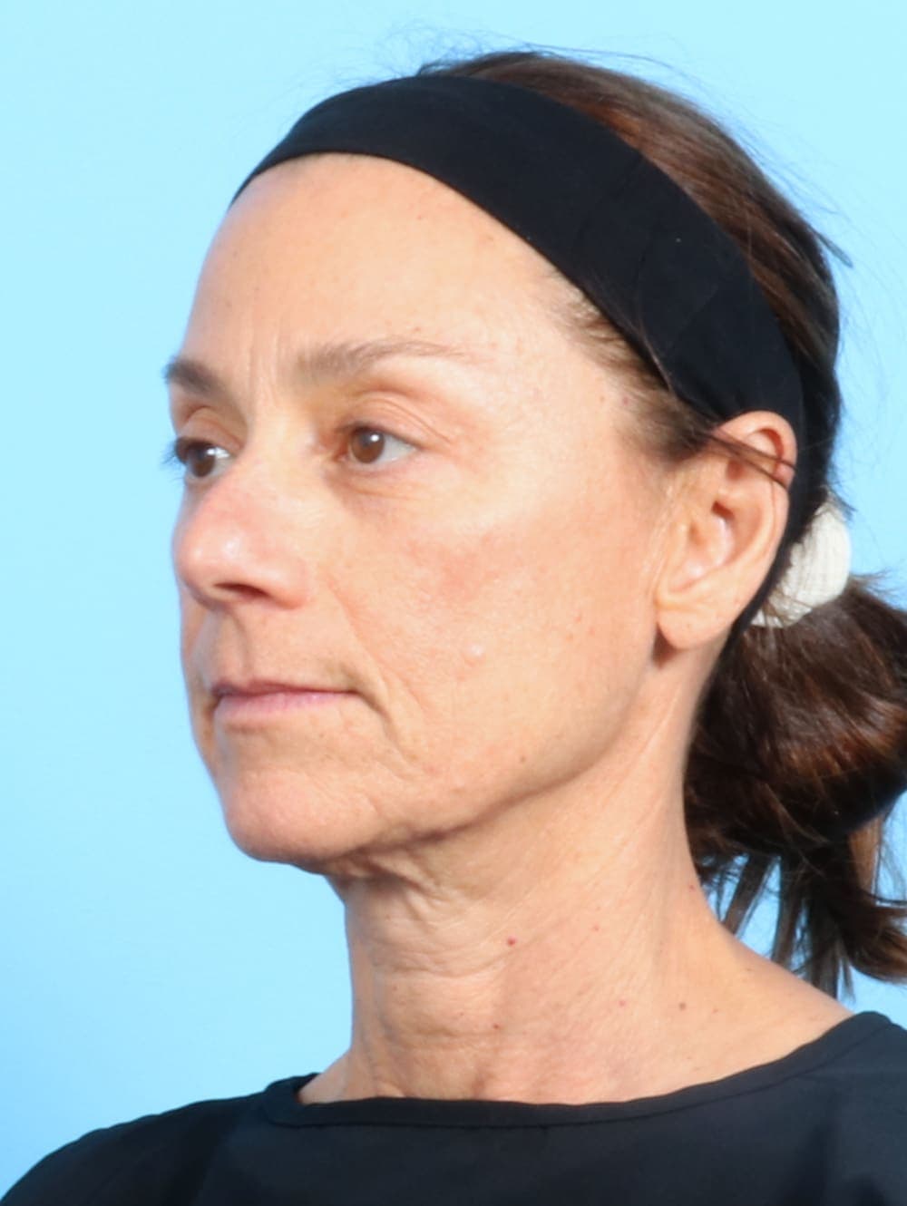 Facelift case #2536 before, image 2