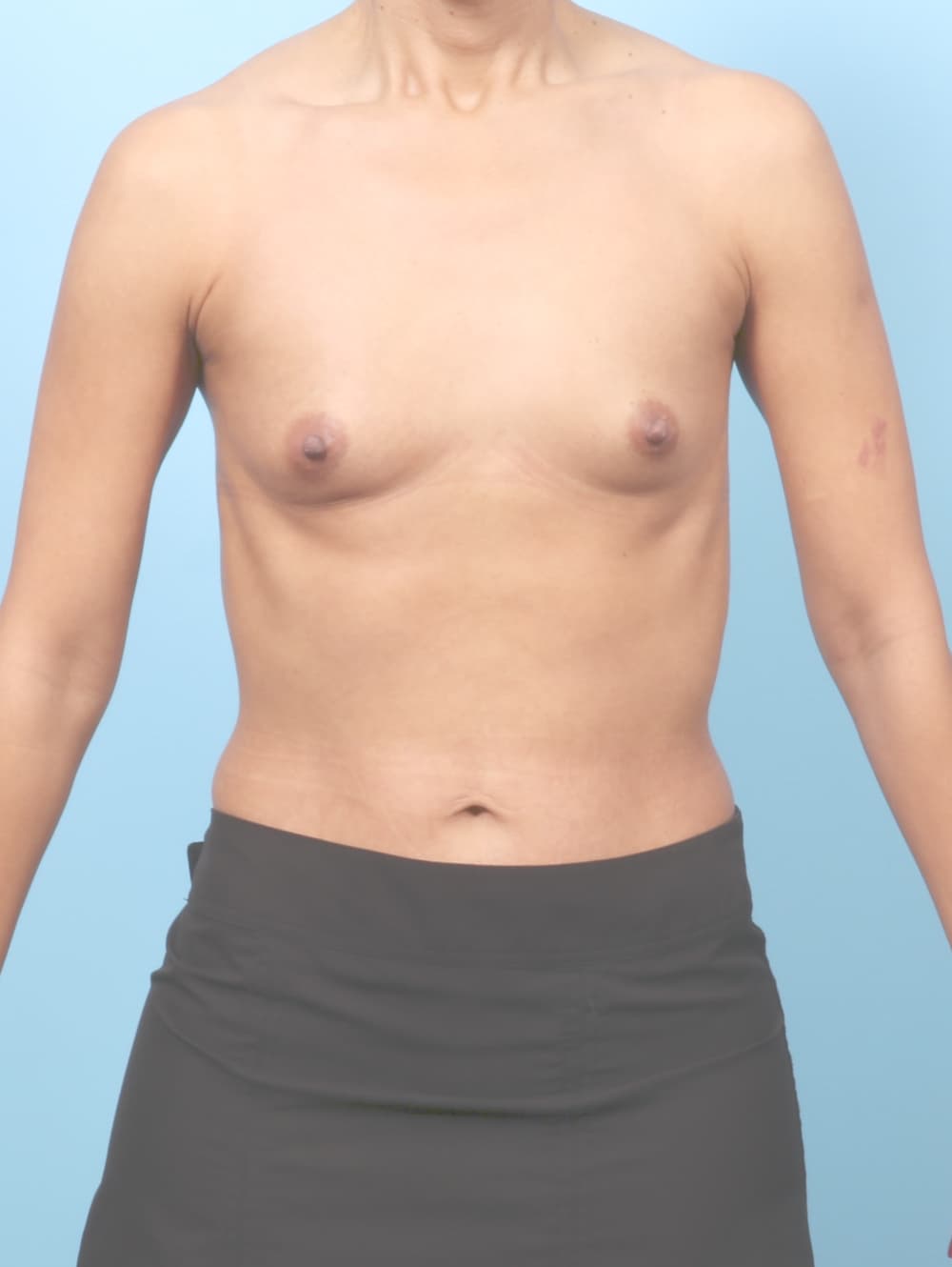 Breast Augmentation case #9028 before, image 1