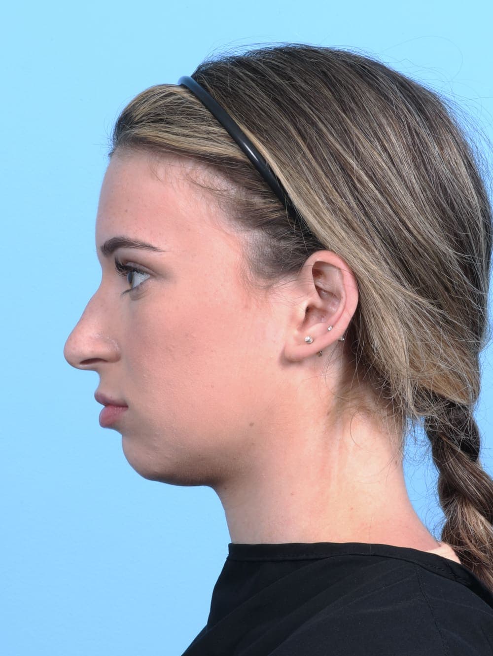 Rhinoplasty case #3153 before, image 1