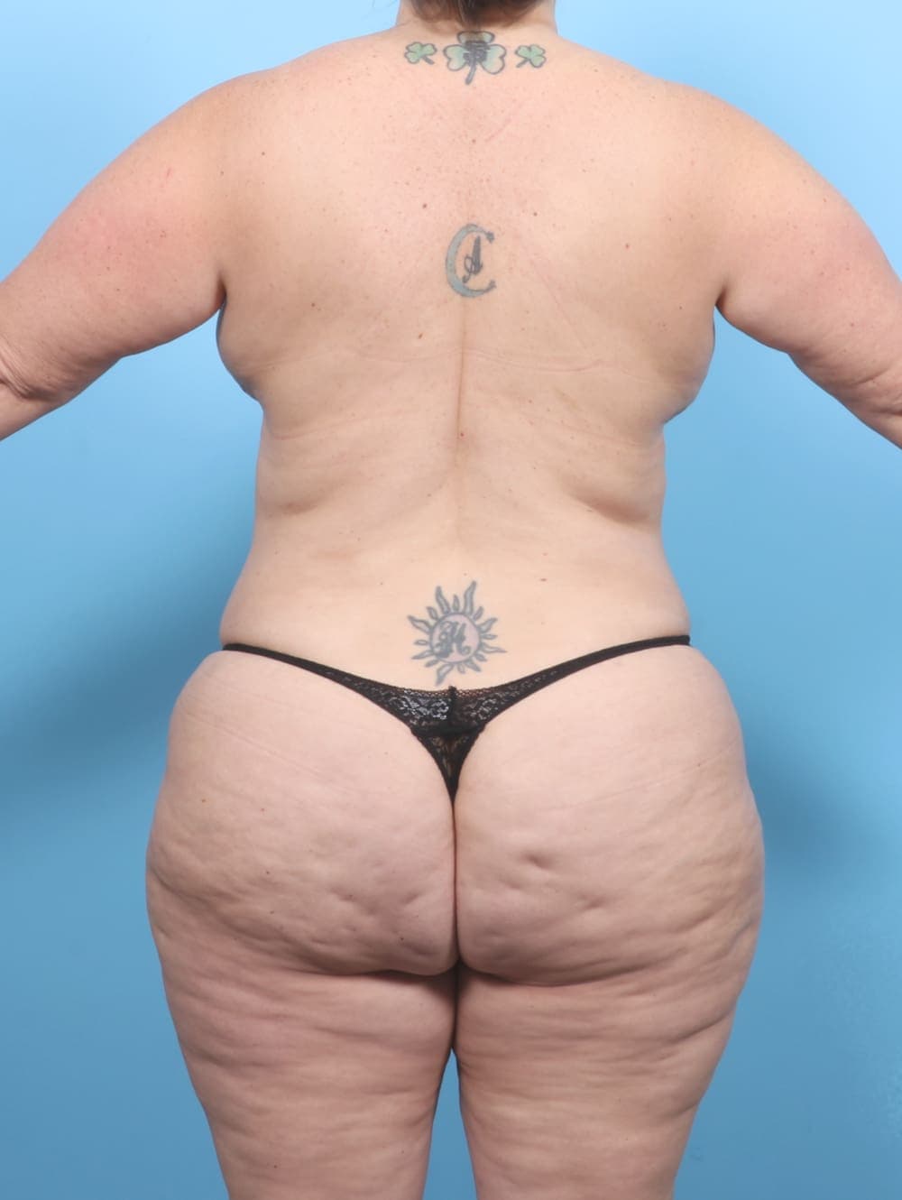 Breast Lift/Reduction case #6793 after, image 4