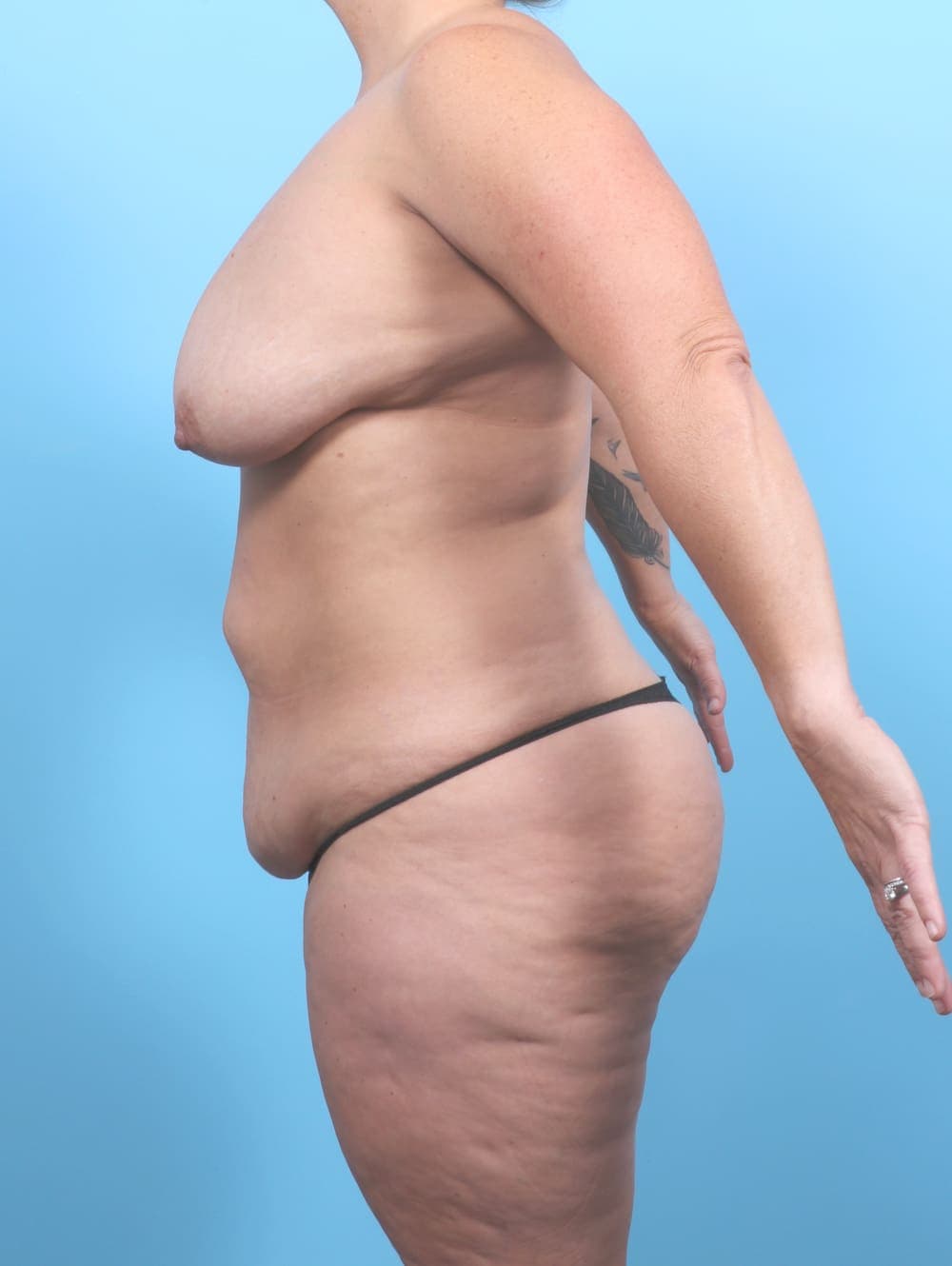 Breast Lift/Reduction case #6793 before, image 3