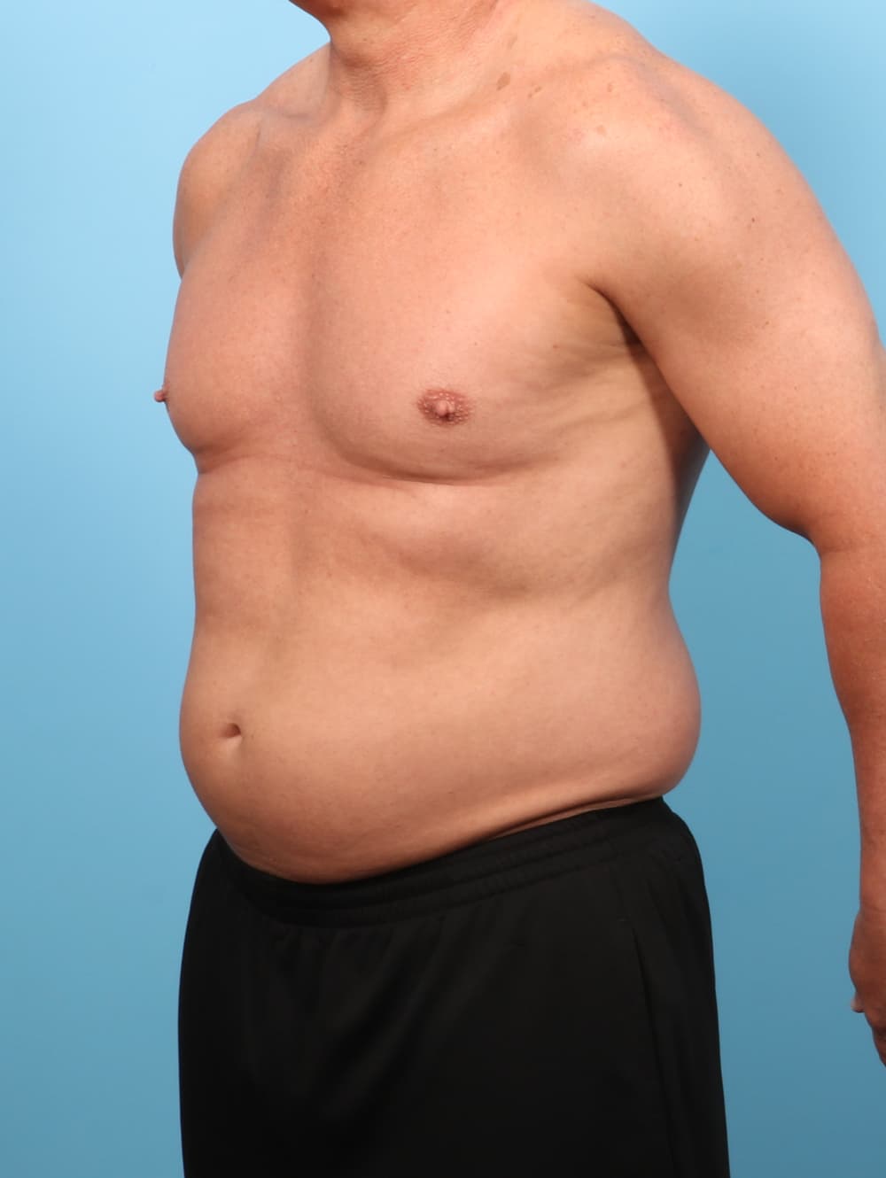 Liposuction case #8992 before, image 2