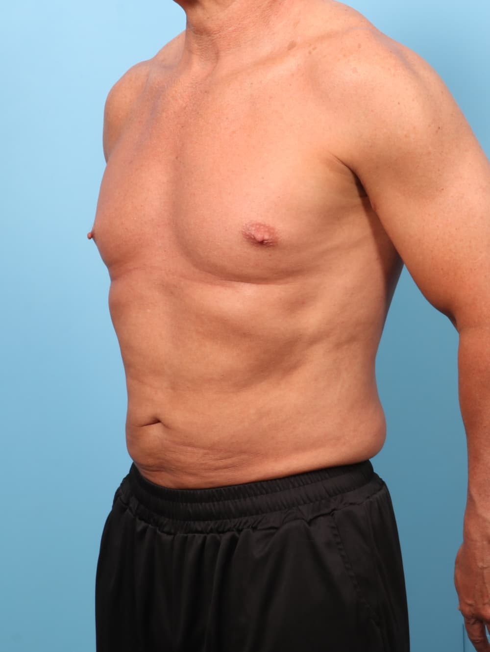 Liposuction case #8992 after, image 2