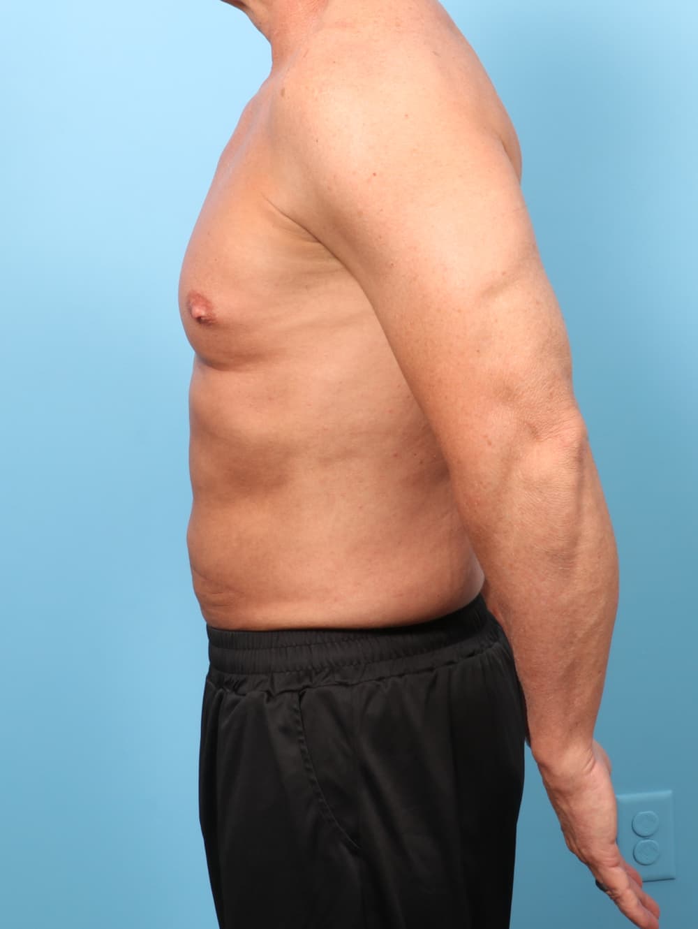 Liposuction case #8992 after, image 3