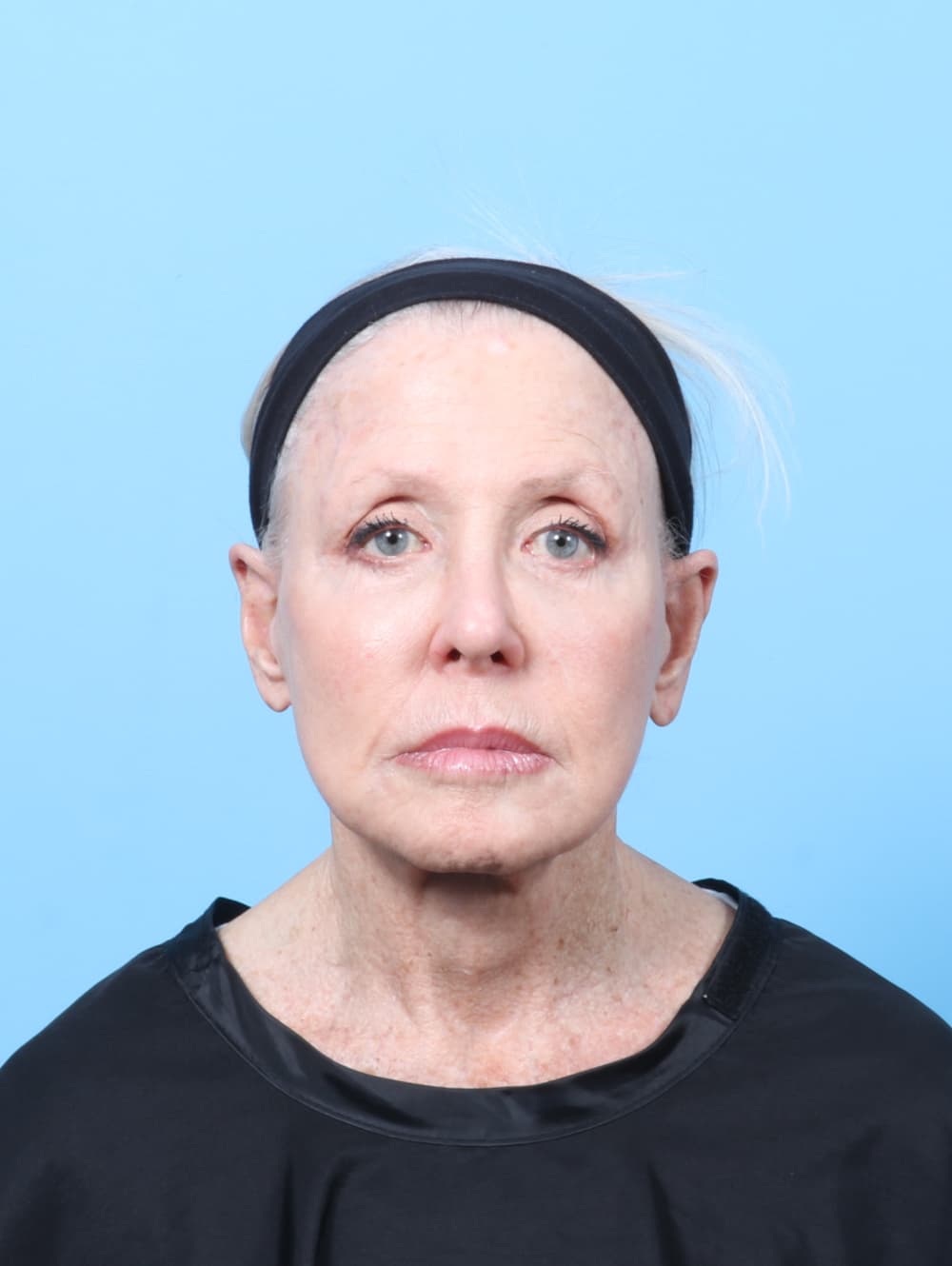 Facelift case #9021 after, image 1
