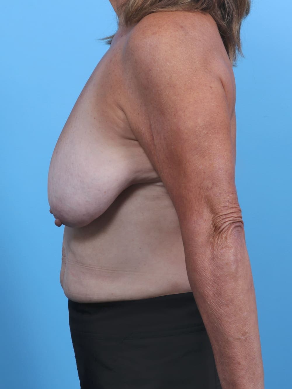 Breast Lift/Reduction case #4963 before, image 3