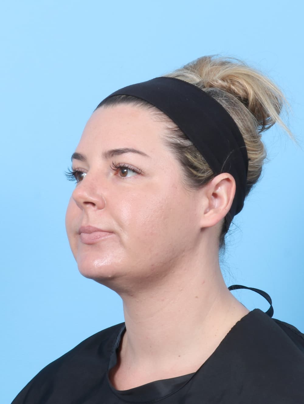 Facial Liposuction case #8195 after, image 2