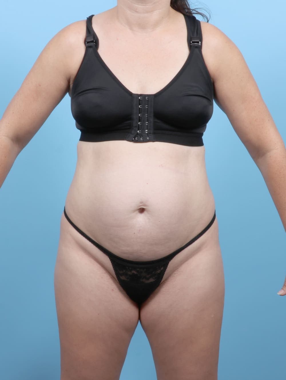 Tummy Tuck case #6777 before, image 1