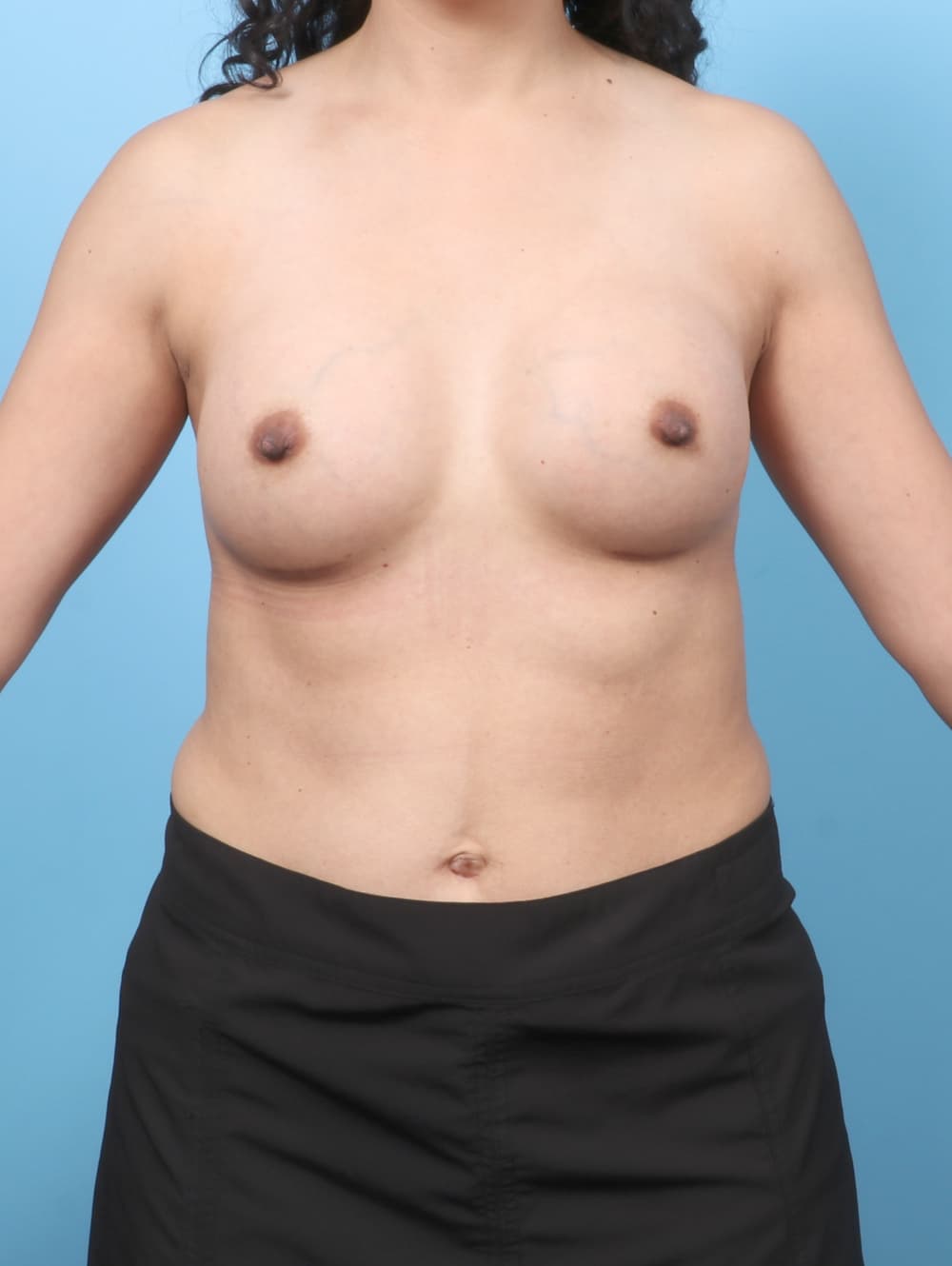 Breast Augmentation case #8110 after