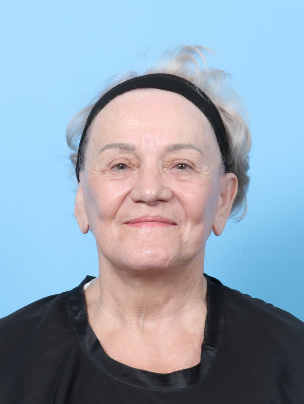 Facelift case #8177 after