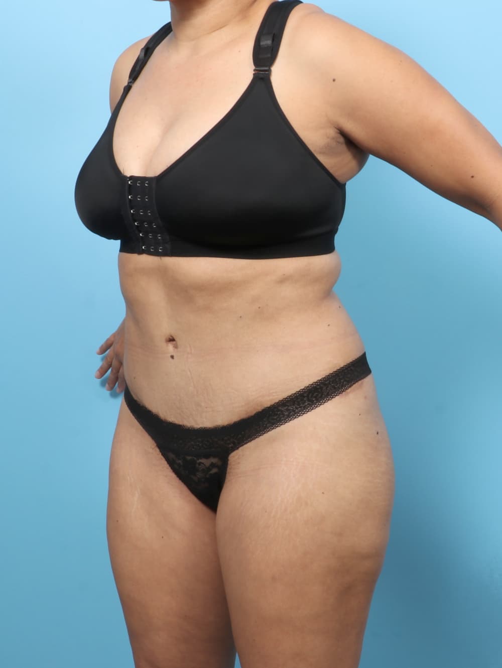 Tummy Tuck case #7574 after, image 2