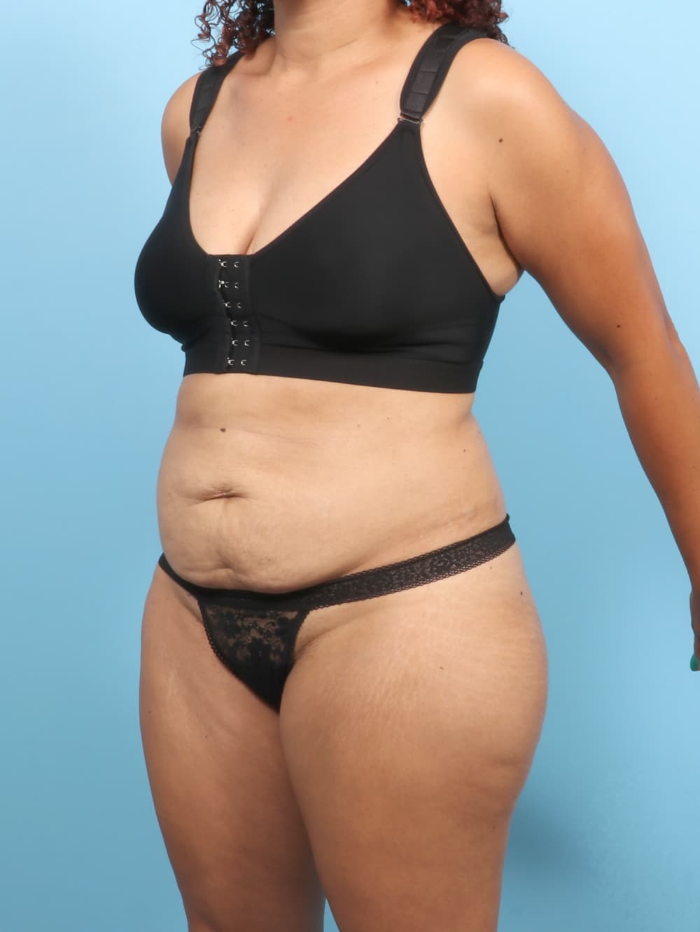Tummy Tuck case #7574 before, image 2