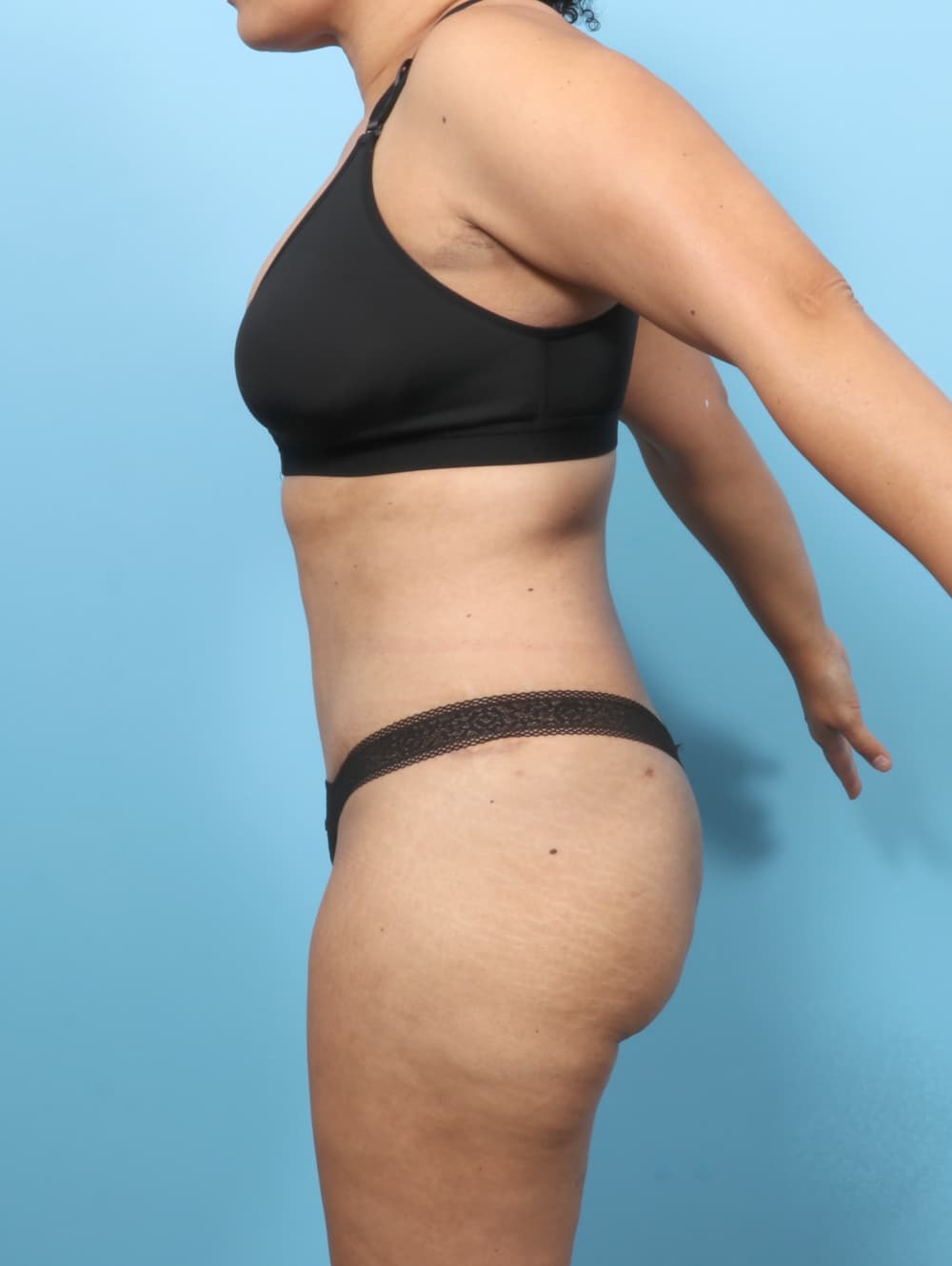 Tummy Tuck case #7574 after, image 3