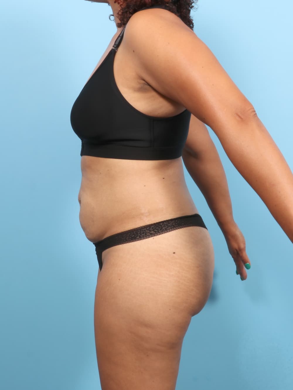 Tummy Tuck case #7574 before, image 3