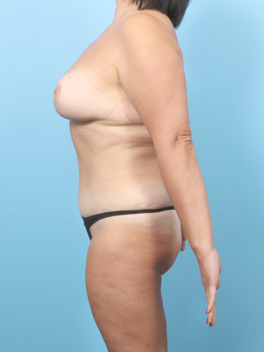 Breast Lift/Reduction case #7660 after, image 3