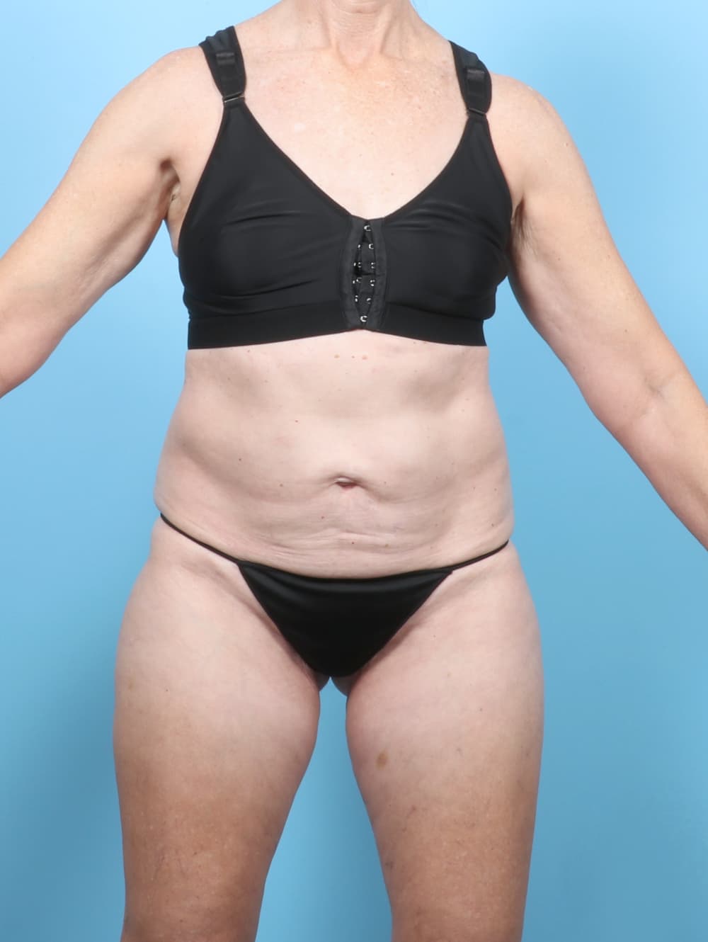 Tummy Tuck case #8046 before, image 1