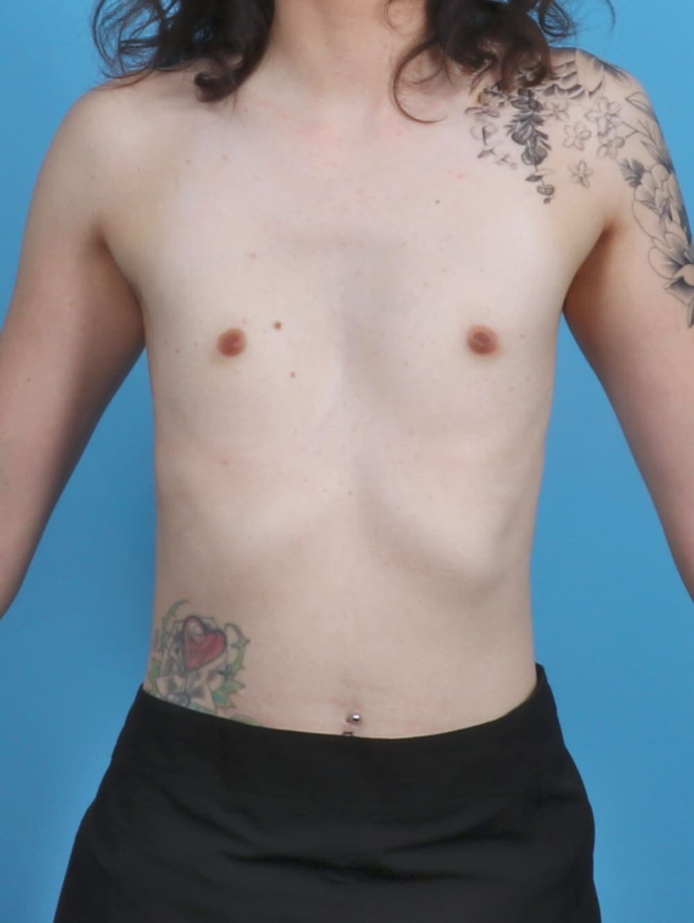 Breast Augmentation case #4818 before, image 1